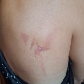 Yolculuk Sırasında Sıcak Su Kazası Ve İlgisizlik Nedeniyle Mağduriyet