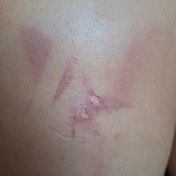 Yolculuk Sırasında Sıcak Su Kazası Ve İlgisizlik Nedeniyle Mağduriyet