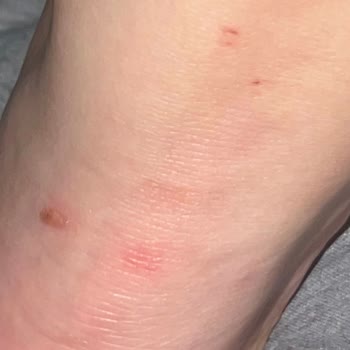 Vans Ayakkabı Her Giyişte Ayağımı Yara Yaptı, Acıdan Topal Geziyorum