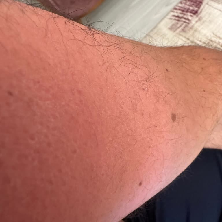 Mustela Güneş Kremi Bebeğimde Alerji Ve Döküntü Yaptı Cildi Korumadı