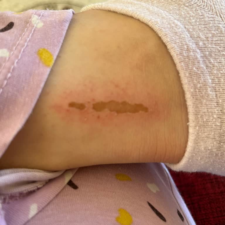 Ayak Bakım Maskesi Sonrası Cilt Soyulması Ve Kaşıntı