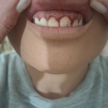 Yanlış Tedavi Sonucu Diş Kaybı Ve Maddi Zarar Yaşadım