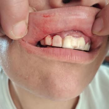 Yanlış Tedavi Sonucu Diş Kaybı Ve Maddi Zarar Yaşadım