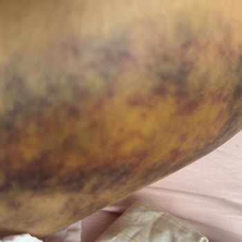 Yanlış Teşhis Ve İhmal Sonucu Ayağımda Kırık Tespit Edildi