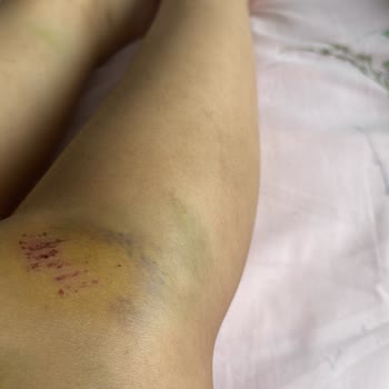 Yanlış Teşhis Ve İhmal Sonucu Ayağımda Kırık Tespit Edildi