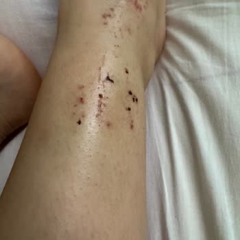 Yanlış Teşhis Ve İhmal Sonucu Ayağımda Kırık Tespit Edildi