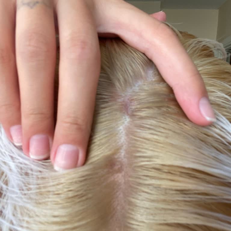 Saç Boyası Kullanımı Sonrası Şiddetli Ağrı Ve Yaralanma