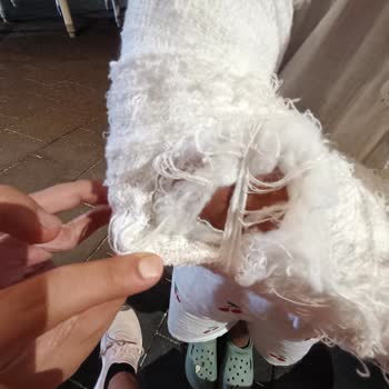 Kızımın Kırık Kolu İçin Yapılan Hatalı Alçı Uygulaması