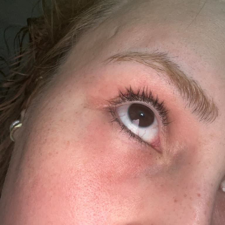 Güneş Kreminde Formül Değişikliği Ve Ciltte Alerjik Reaksiyon