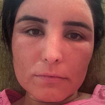 C Vitamini Serumundan Sonra Yüzümde Şiddetli Alerjik Reaksiyon Oluştu