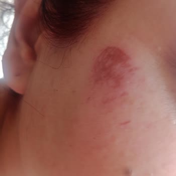 Yanlış Uygulama Sonucu Yüzünde Yanık Oluştu