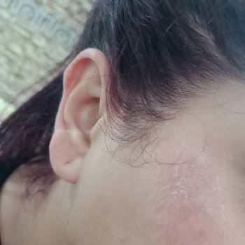 Yanlış Uygulama Sonucu Yüzünde Yanık Oluştu