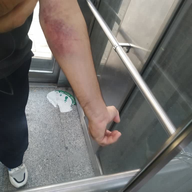 Türk Kızılay Kan Bağışı Sonrası Kolumda Ciddi Morarma Ve Mağduriyet