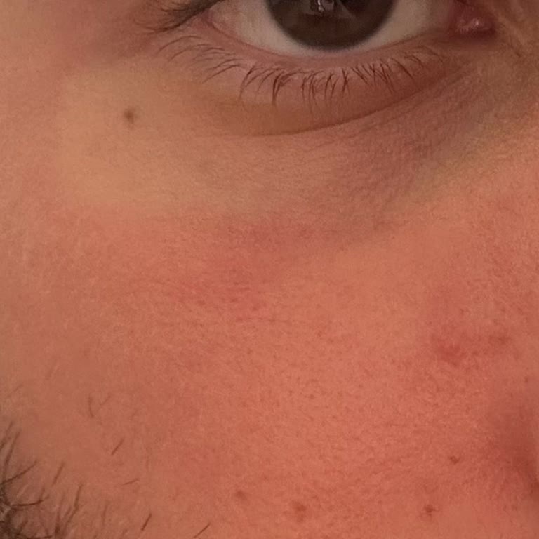 Yves Rocher Yüz Yıkama Jeli Cildimde Ciddi Kızarıklık Ve Yanmaya Sebep Oldu