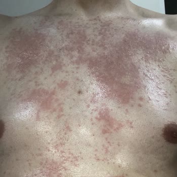 Isana Men Tüy Dökücü Krem Sonrası Ciddi Kaşıntı Ve Deri Döküntüsü Yaşadım