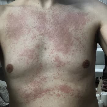 Isana Men Tüy Dökücü Krem Sonrası Ciddi Kaşıntı Ve Deri Döküntüsü Yaşadım