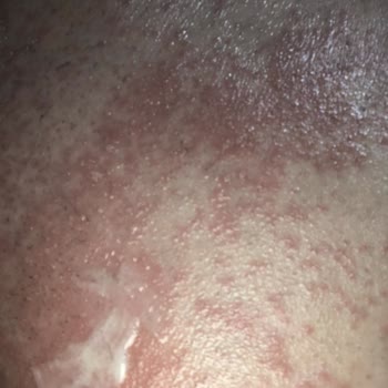 Isana Men Tüy Dökücü Krem Sonrası Ciddi Kaşıntı Ve Deri Döküntüsü Yaşadım