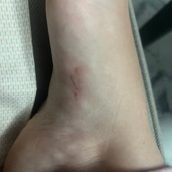 Skechers Sandalet Ayağımı Yaraladı, Değişim Talebim Reddedildi