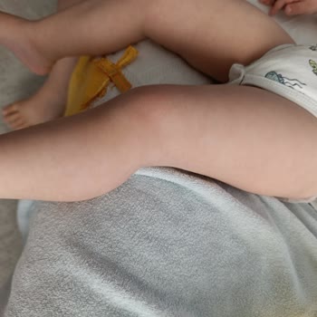 Dalin Şampuan Sonrası Bebeğimde Ciddi Alerjik Reaksiyon Yaşadık