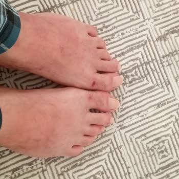 Gezer Terlik Ayak Parmağımda Sürekli Yara Yaptı