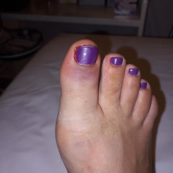 Hayal Kırıklığıyla Başlayan Tatil Ve Yaşanan Talihsiz Kaza