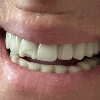 İmplant Ve Protez Dişte Tekrarlayan Sorunlar Ve İlgisiz Hizmet