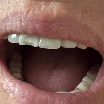 İmplant Ve Protez Dişte Tekrarlayan Sorunlar Ve İlgisiz Hizmet