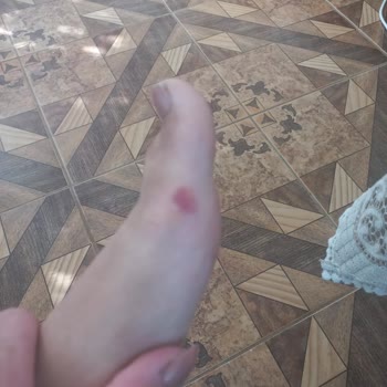 Kısa Sürede Ayakları Yaralayan Ayakkabıya Çözüm Bulunmuyor