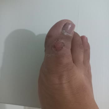 Kısa Sürede Ayakları Yaralayan Ayakkabıya Çözüm Bulunmuyor