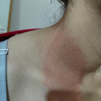 Bebekler İçin Güvenli Denilen Sprey Boynumda Yanık Oluşturdu