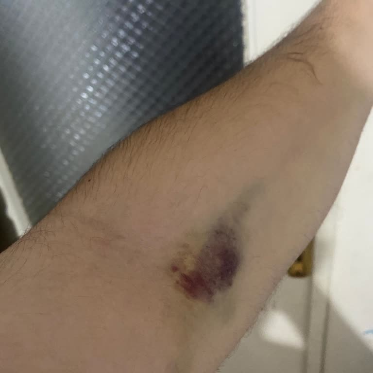 Türk Kızılay Kan Bağışı Sırasında Dikkatsiz İğne Uygulaması Sonrası Geçmeyen Morluk Ve Ağrı Yaşadım