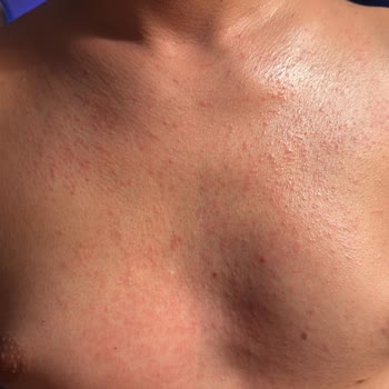 Veet Tüy Dökücü Krem Cildimi Yaktı, Açıklama Bekliyorum