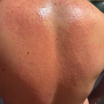 Veet Tüy Dökücü Krem Cildimi Yaktı, Açıklama Bekliyorum