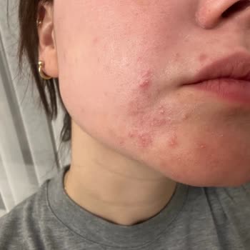 Neutrogena Acne Plus Gave Me Burning Skin