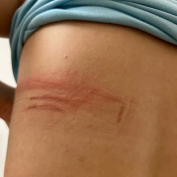 Satın Aldığım Sütyenler Cildimde Yaralara Sebep Oldu, Para İadesi Talep Ediyorum