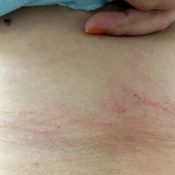 Satın Aldığım Sütyenler Cildimde Yaralara Sebep Oldu, Para İadesi Talep Ediyorum