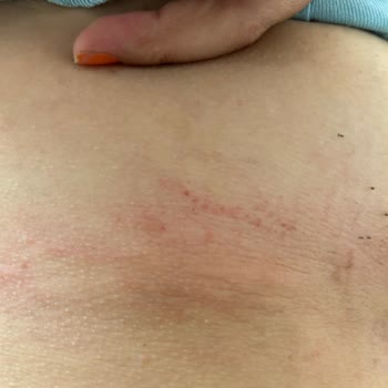 Satın Aldığım Sütyenler Cildimde Yaralara Sebep Oldu, Para İadesi Talep Ediyorum