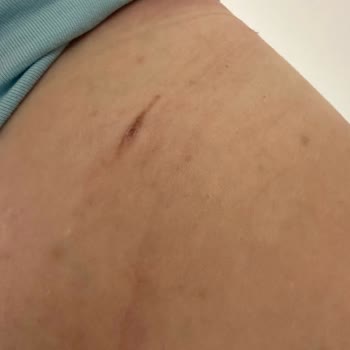 Satın Aldığım Sütyenler Cildimde Yaralara Sebep Oldu, Para İadesi Talep Ediyorum