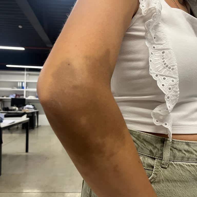 Serum Uygulaması Sonrası Kolda Kalıcı İz Ve Hastaneden Yanıtsızlık