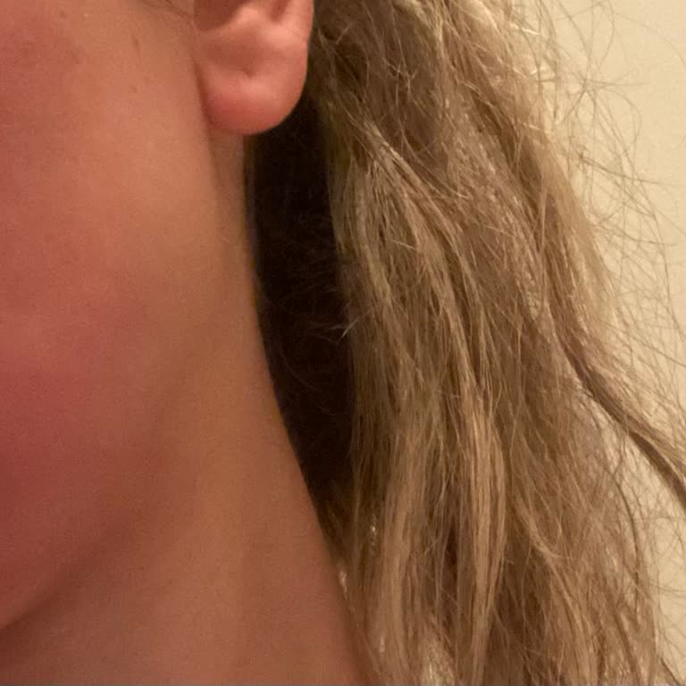 The Purest Solutions Hyaluronik Asit Tester Yüzümde Alerji Yaptı