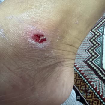 Güneşte Eriyen Ürün Ayağımı Yaraladı, İade Talep Ediyorum