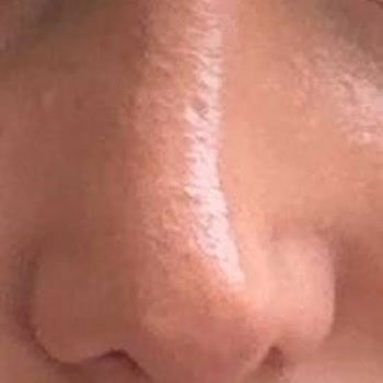 Op. Dr. Seyithan Kırtay Burun Estetiği Sonrası Hayal Kırıklığı Ve Özgüven Kaybı Yaşıyorum