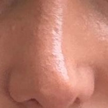 Op. Dr. Seyithan Kırtay Burun Estetiği Sonrası Hayal Kırıklığı Ve Özgüven Kaybı Yaşıyorum