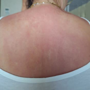 Dermokil Güneş Kremi Yetersiz Koruma Nedeniyle Güneş Yanığına Sebep Oldu