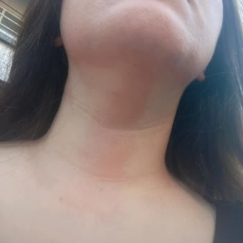 Güneş Kremi Ve Toniği Cildimde Yanma Yaptı, Markadan Memnun Kalmadım