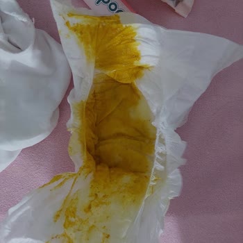 Aldığım Mama Bebeğimde Şiddetli İshal Yaptı