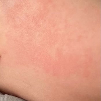 Hipp Organik Mama Sonrası Alerjik Reaksiyon Ve İletişim Sorunu