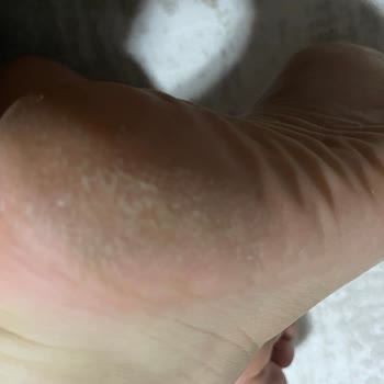 Sert Derili Nike Ayakkabı Ayağımda Yara Ve Mantar Oluşturdu, İade Talebim Reddedildi