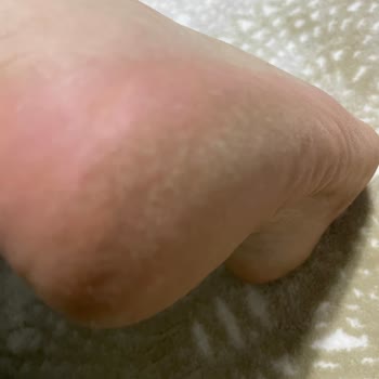 Sert Derili Nike Ayakkabı Ayağımda Yara Ve Mantar Oluşturdu, İade Talebim Reddedildi