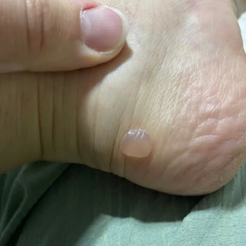 Sert Derili Nike Ayakkabı Ayağımda Yara Ve Mantar Oluşturdu, İade Talebim Reddedildi